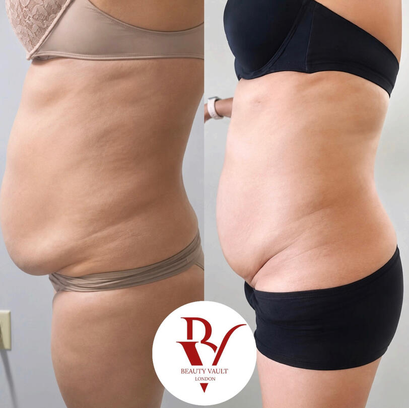 Body Contouring