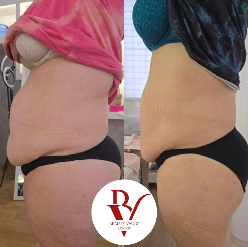 Body Contouring