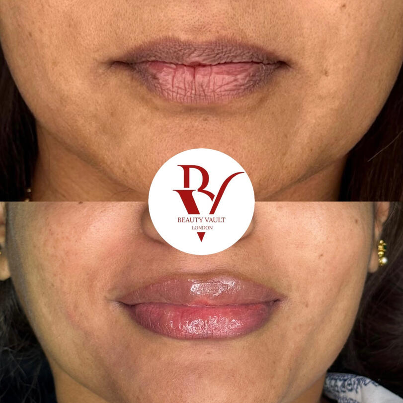 Lip Neutralisation