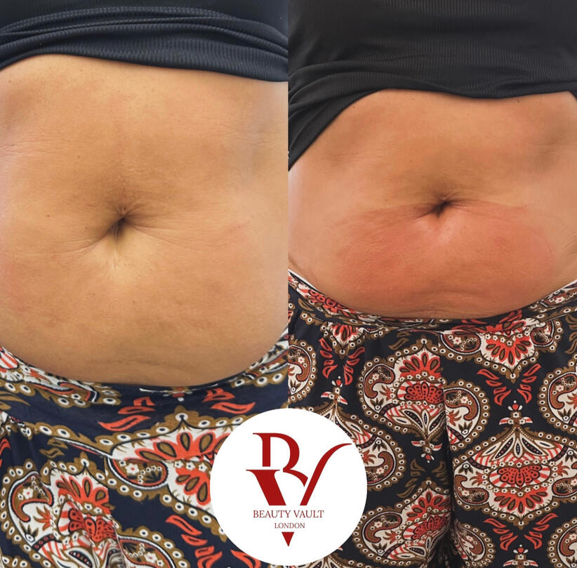 Fat Freezing (Cryolipolysis)