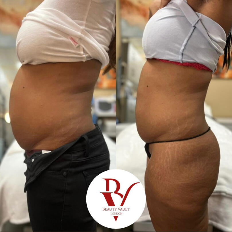 Body Contouring